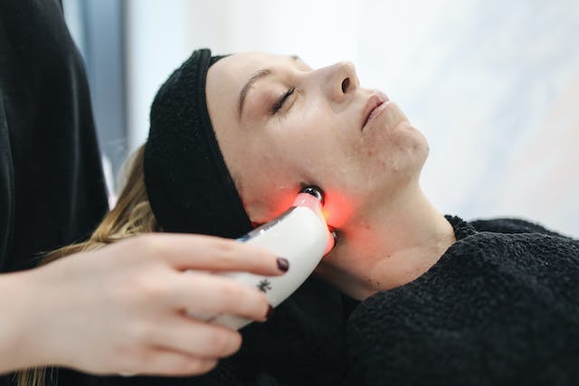 laser remove brown spots on face