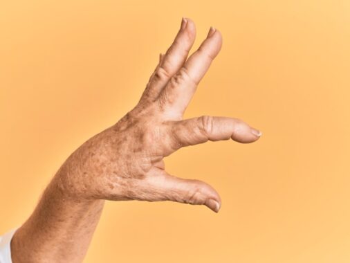 Age Spot on Hands