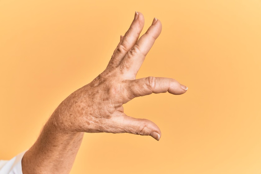 Age Spot on Hands